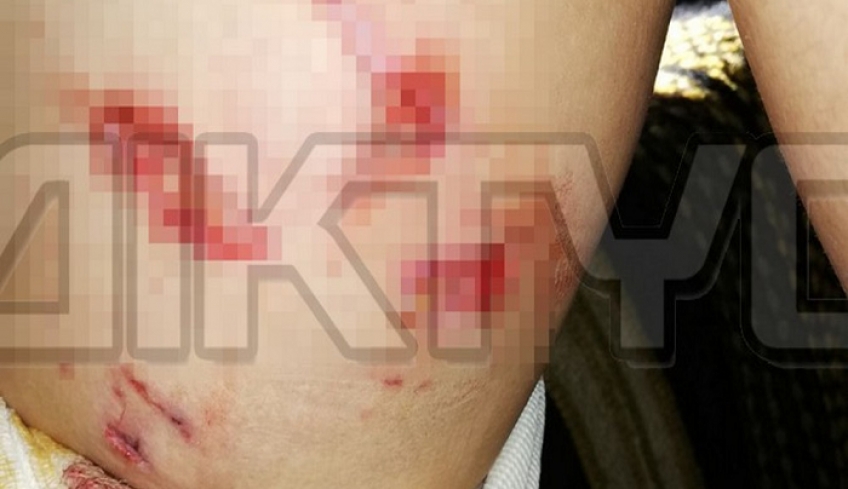 Σοκ στις Σέρρες: Σκύλος δάγκωσε 11χρονο παιδί