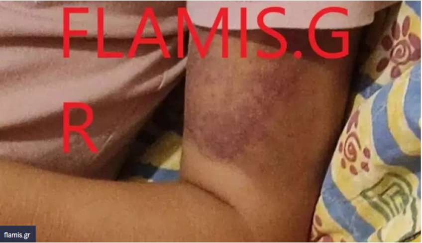 Πάτρα: Θύμα κακοποίησης 16χρονη από τον 25χρονο φίλο της - Η καταγγελία της μητέρας της