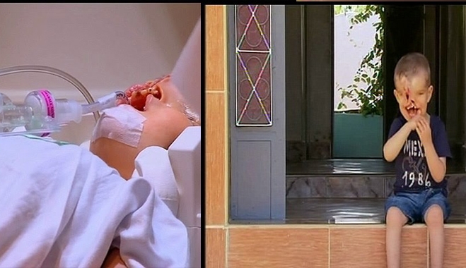 Η συγκινητική ιστορία του αγοριού που γεννήθηκε χωρίς πρόσωπο