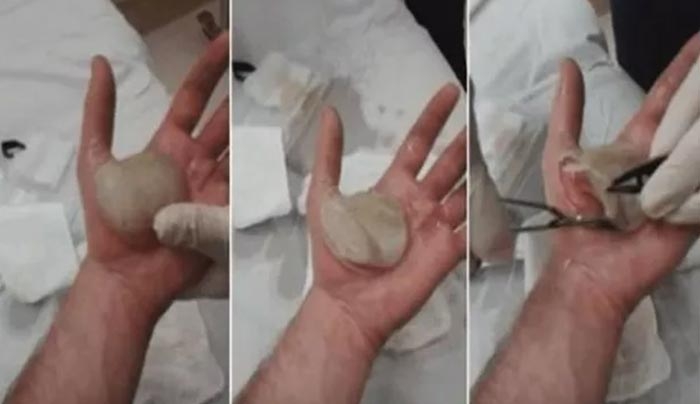 Είχε στο χέρι του μια «μπάλα» γεμάτη πύον. Όταν την σπάει…ΔΕΙΤΕ! (Βίντεο)